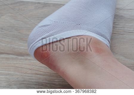 Water Corns On Heels Of A Woman In White Socks, Rub The Calluses With New Shoes. Grated Bloody Blown