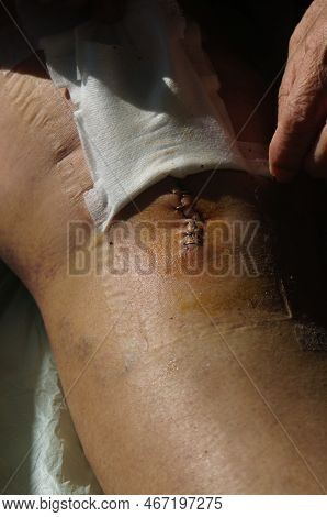 Surgical Suture On The Knee. Surgical Wound Sutured With Special Metal Suture For Healing. Total Kne