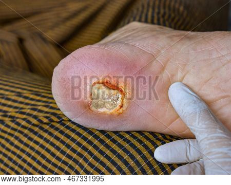Diabetes Foot Ulcer In The Foot Of Asian  Male Patient.