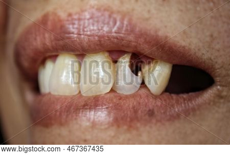 Incisors Partially Perforated On Maxillary Teeth Closeup View