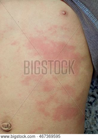 Rash Over Trunk Of Asian Young Man. Widespread Macular Skin Lesions.