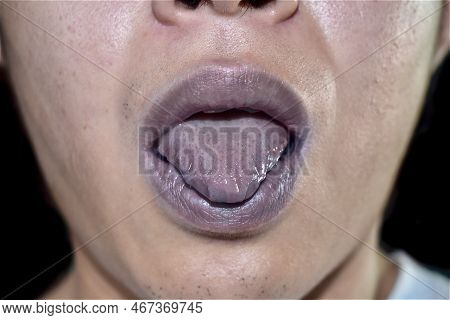 Cyanotic Lips Or Central Cyanosis At Southeast Asian Young Man With Congenital Heart Disease.
