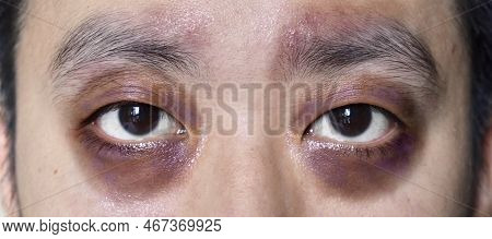 Raccon Eyes Or Periorbital Ecchymosis Or Panda Eye Sign In Southeast Asian Young Male Patient. It Is