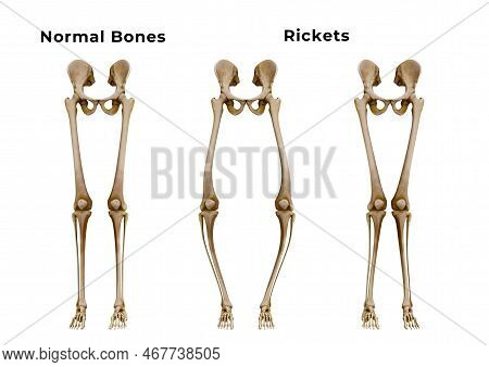 Rickets Is A Metabolic Disease Characterized By Deformities Of The Bones. The Most Common Symptoms A
