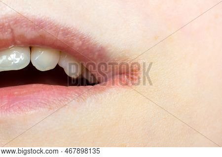 Woman Lips Skin With Herpes Labialis Virus Close Up.