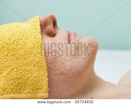 Acne Treatment