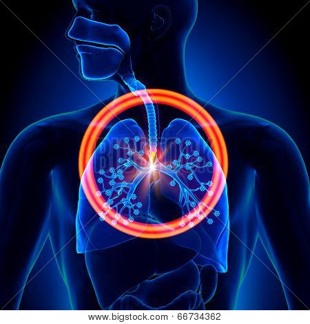 Lungs Foreign Object - inhaled or swallowed