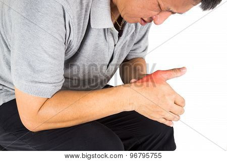 Man with painful and inflamed gout on his hand around the thumb area.
