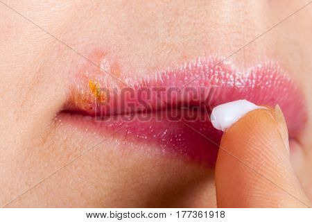 Herpes on the lip close-up macro. Woman lubricates the labial herpes ointment.