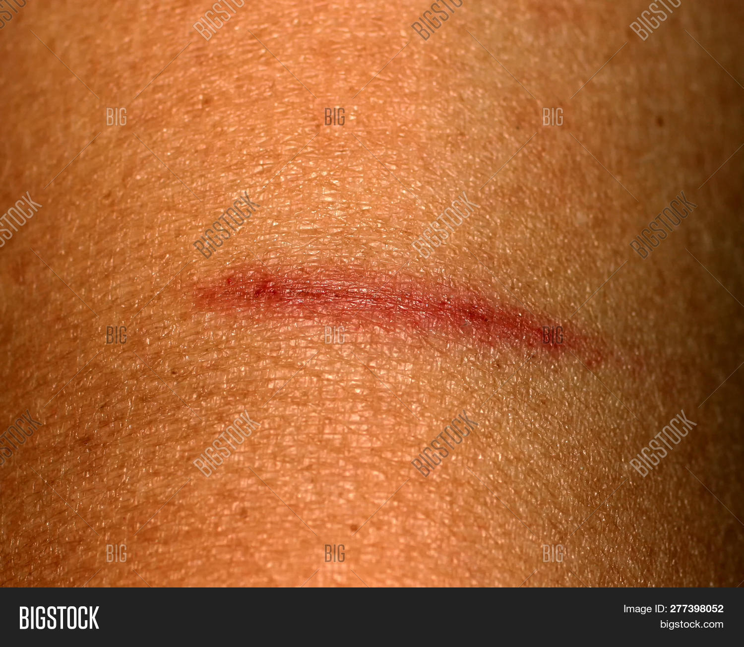 Cut On Skin. Wound, Image & Photo (Free Trial) Bigstock