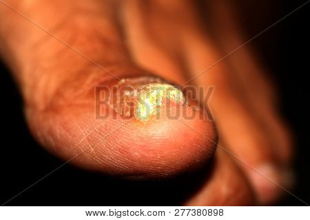 The Nail Is Infected With A Fungus. Thickening Of The Nail On The Leg. Psoriasis On The Nail