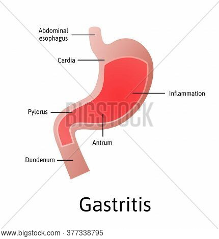 Gastritis, An Inflammation, Irritation, Or Erosion Of The Lining Of The Stomach. Medical Vector Illu