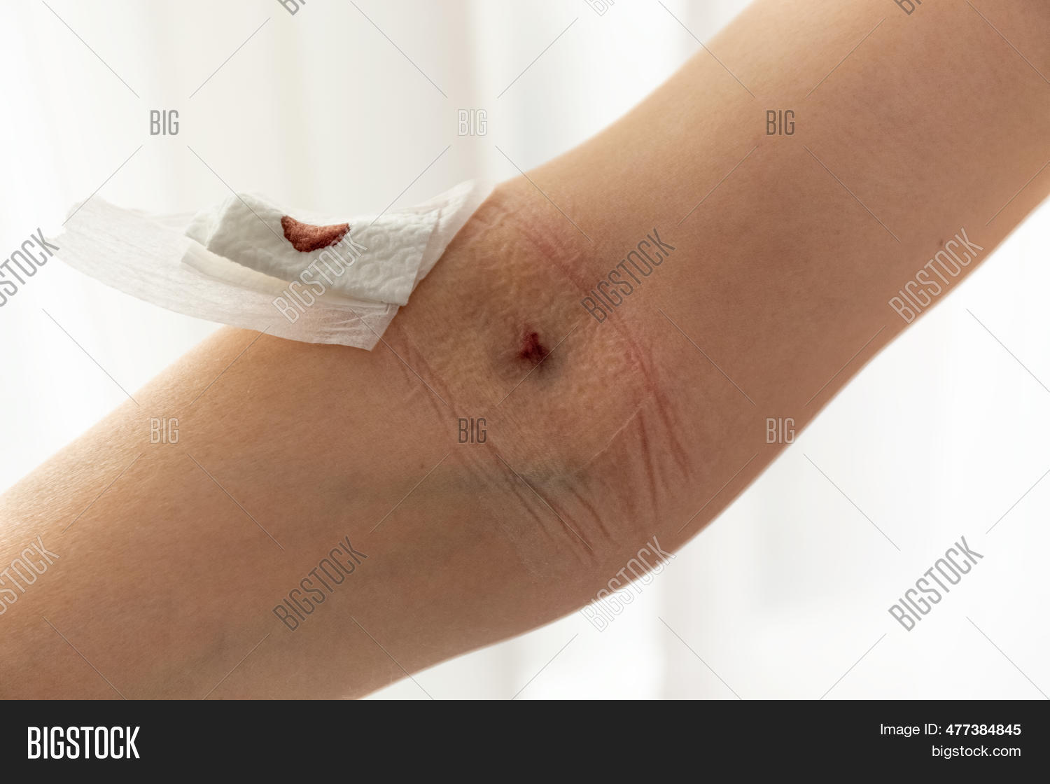 Bruise Needle On Arm. Image & Photo (Free Trial) Bigstock