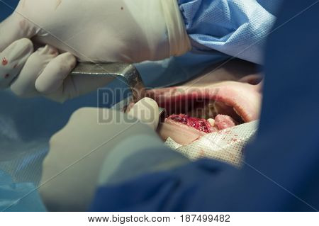 Surgeon stretches the mouth during the maxillofacial surgery close up
