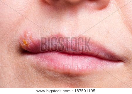 Herpes on the lip close up macro.