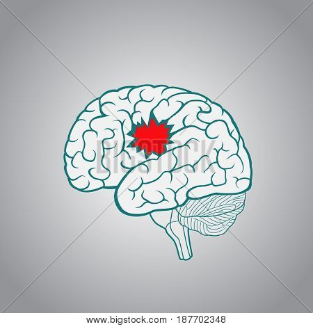 A brain with a hole, the concept of destruction of the brain, memory, stroke