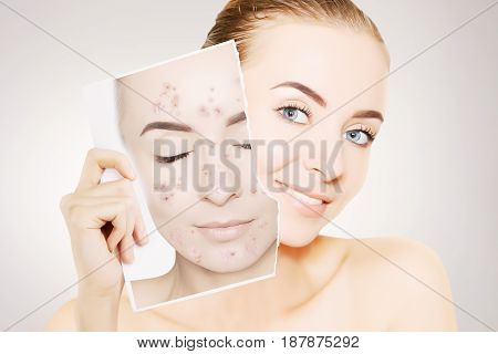 gorgeous woman with perfect skin releases her face from pimples