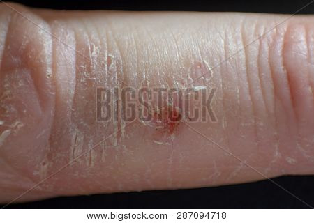 Hand Dermatitis. Hand Eczema Closed On Black Background