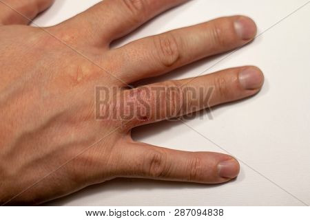 Hand Dermatitis. Hand Eczema Closed On Black Background
