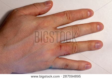Hand Dermatitis. Hand Eczema Closed On Black Background