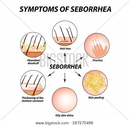 Symptoms Of Seborrhea. Seborrhea Skin And Hair. Dandruff, Seborrheic Dermatitis. Baldness, Hair Grow