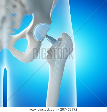 3d rendered illustration of a hip implant
