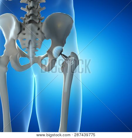 3d rendered illustration of a hip implant