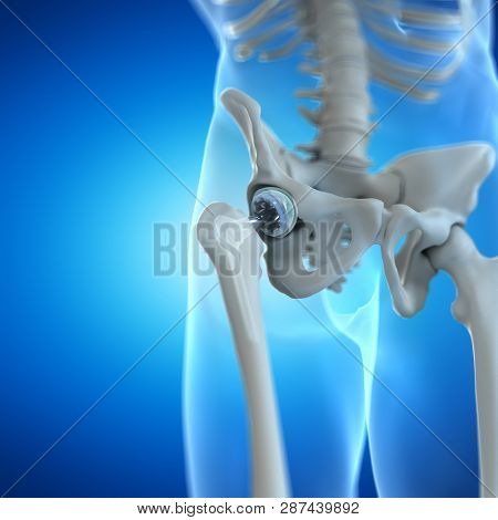 3d rendered illustration of a hip implant