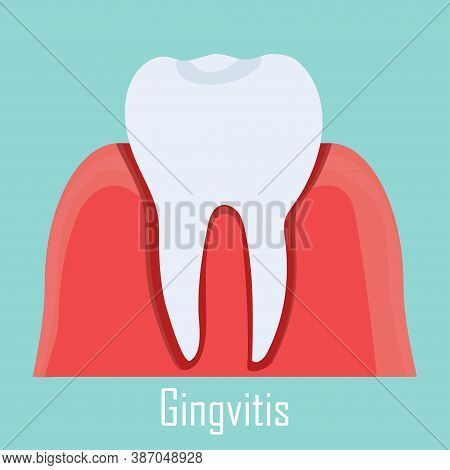 Gingvitis, Gum Illness Isolated Illustration Will Tooth. Dental Care, Stomatology Problem Concept. V