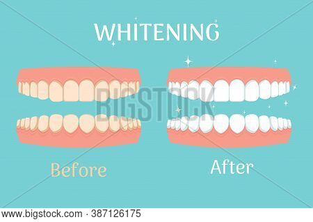 Whitening Teeths Before And After, Stomatology, Dental Concept Isolated. Healthcare And Beauty Stock