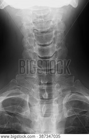 X-ray Image Of Cervical Vertebrae, Frontal View