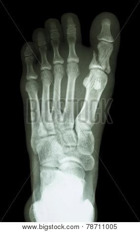Fracture Proximal Phalange At First Toe