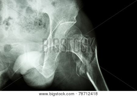 Intertrochanteric Fracture Left Femur