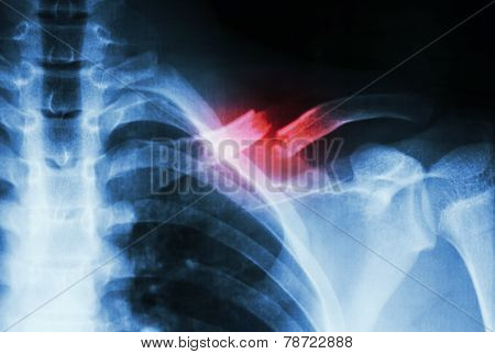 Fracture Left Clavicle