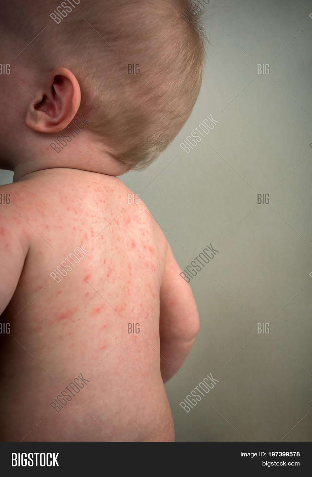 Allergies Pimples On Image Photo Free Trial Bigstock