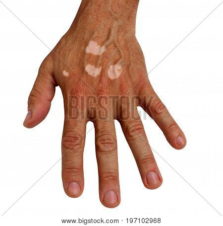 Medical, science  practice of diagnosis of treatment skin vitiligo , white spot disease , on the man's wrist , isolated on white background