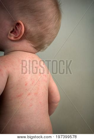 Allergies pimples on the baby's skin. Food allergy. Skin diseases symptoms.
