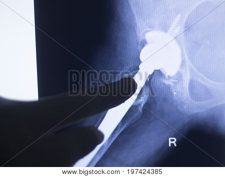 Hip Joint Replacement Impant