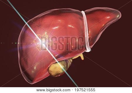 Liver cancer treatment with laser. Conceptual image. 3D illustration