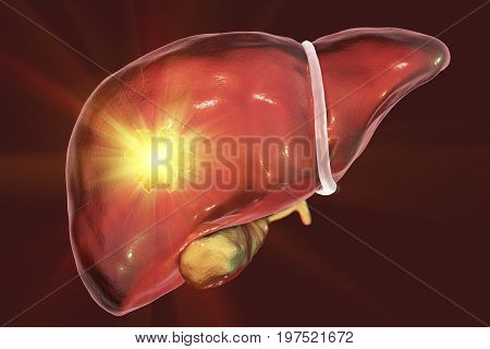 Liver cancer treatment. Conceptual image. 3D illustration