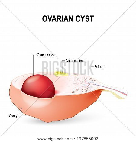 Ovarian cyst. A fluid-filled sac in the ovary.