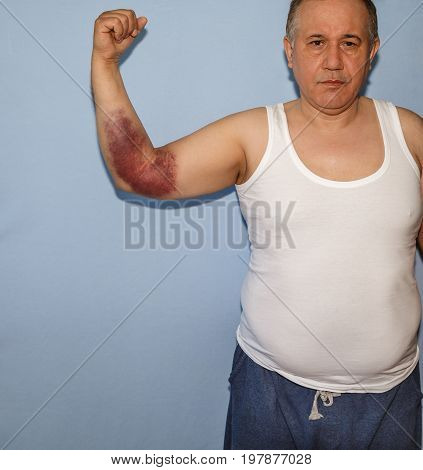 Standing man with a hematoma on his arm on blue background