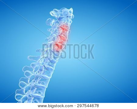 3d rendered medically accurate illustration of painful intervertebral discs