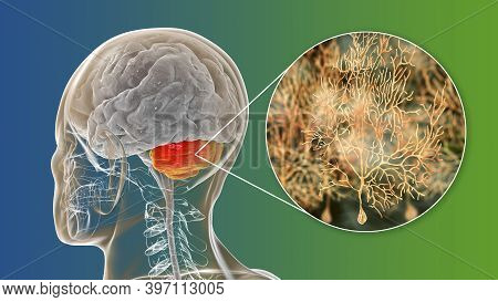 Human Brain With Highlighted Cerebellum And Close-up View Of Purkinje Neurons, One Of The Commonest 