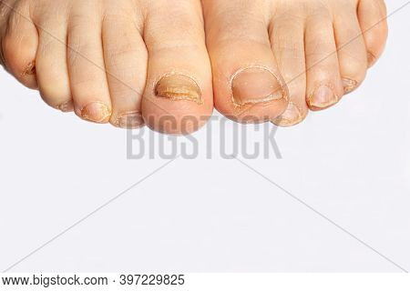 Foot Nail Fungus - A Comparison Of Healthy And Sore Feet. Dermatomicosis And Onyhomicosis, Fungal In