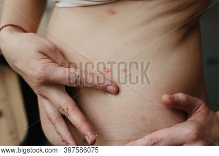 Applying An Emollient To Dry Flaky Skin As In The Treatment Of Psoriasis, Eczema And Other Dry Skin 