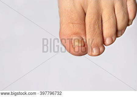 Fungus Of Nails On The Big Toe - Dermatomycosis And Onychomycosis, Fungal Infection Macro Photo. Ing