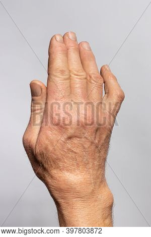 A Human Hand Brush On A Gray Background With Place For Text For Medicine And Traumatology. Ankylosis