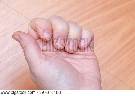 Close-up Of Female Hand With Natural Raw Dirty Nails On Wooden Background. Peeling On Nails. Nail An