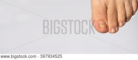 Ingrown Toenail From Wearing Tight Shoes. Nail Fungus Macro Photo, Onychomycosis, Dermatomycosis, My